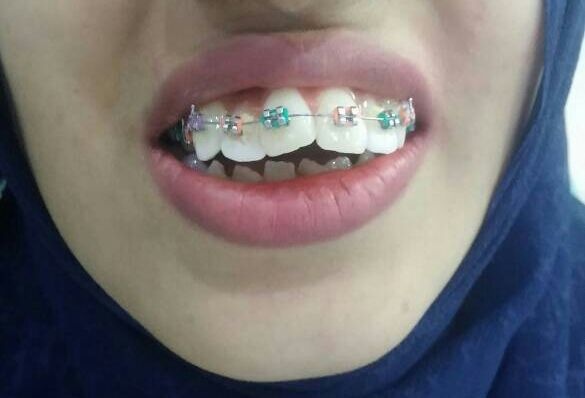 brackets