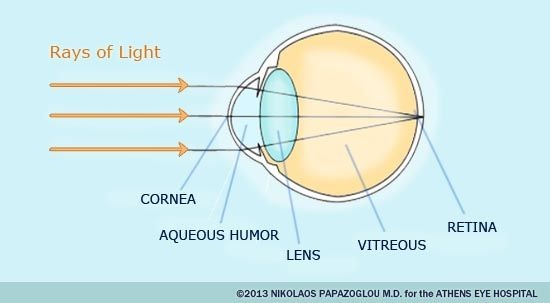 hyperopia