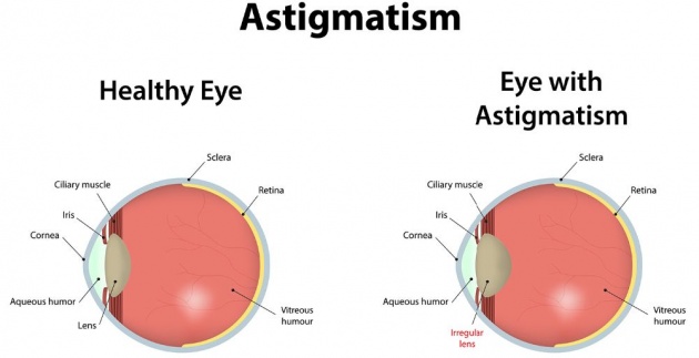 what_is_astigmatism