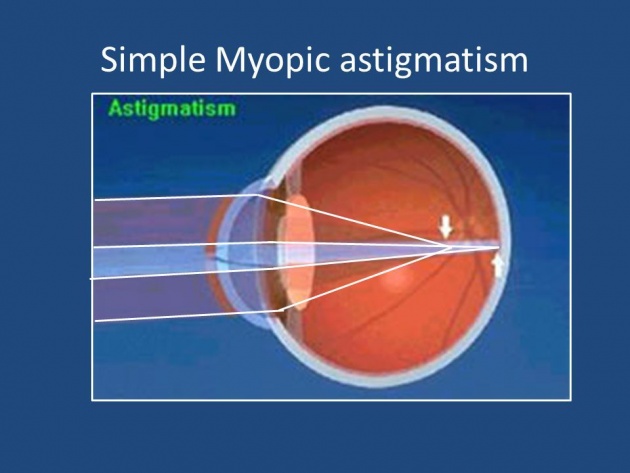 common_causes_of_astigmatism