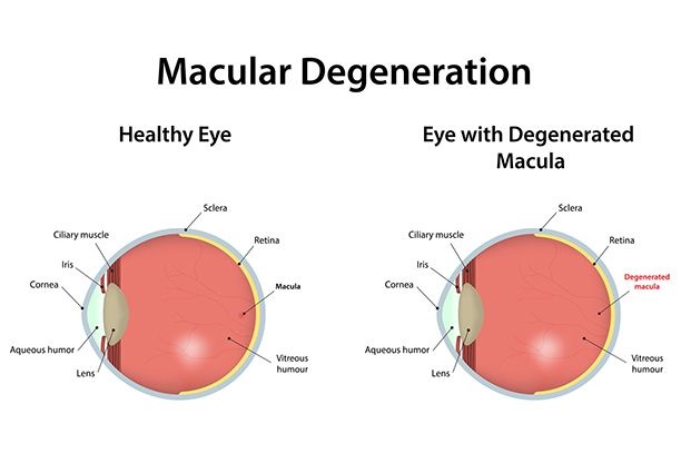 glaucoma