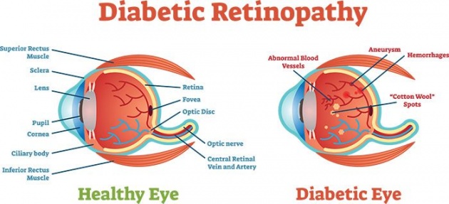 keratoconus