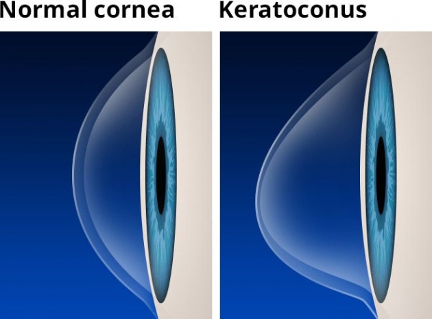 age_related_macular_degeneration