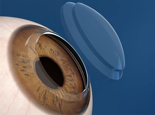 cause_of_keratoconus