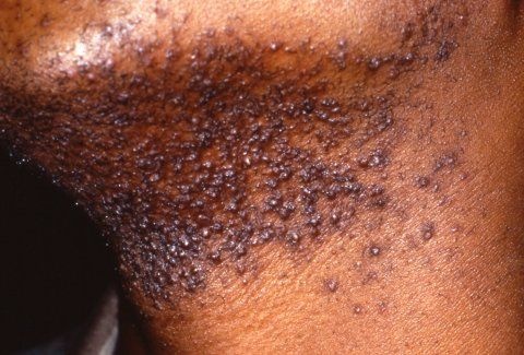 skin_diseases_pictures