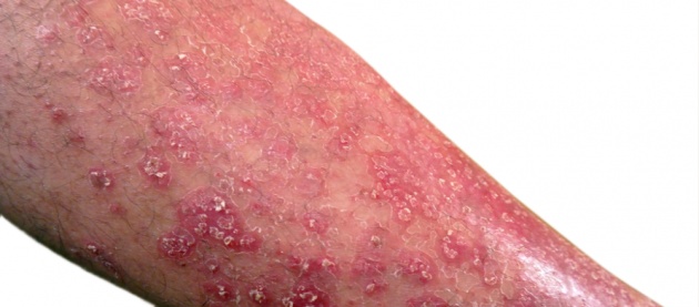 list_of_skin_disease_and_medical_conditions